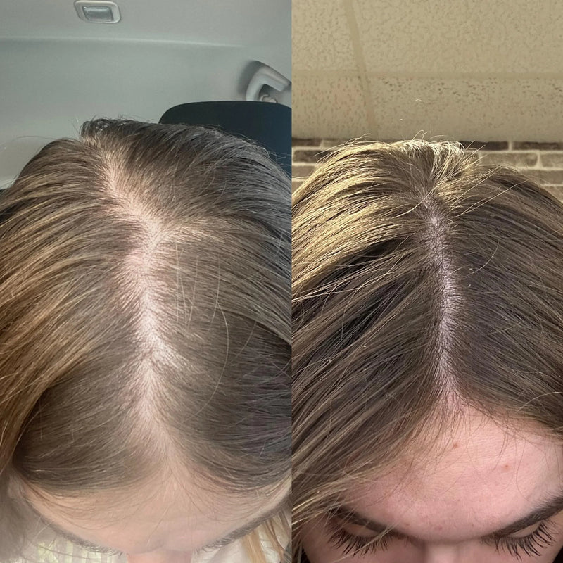 💪✨ Kit minoxidil + dermaroller
